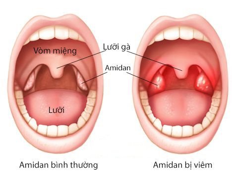 Viêm amidan