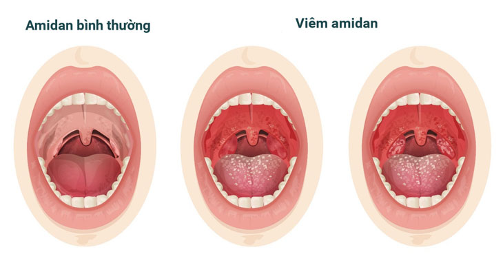 Amidan bình thường và amidan bị viêm