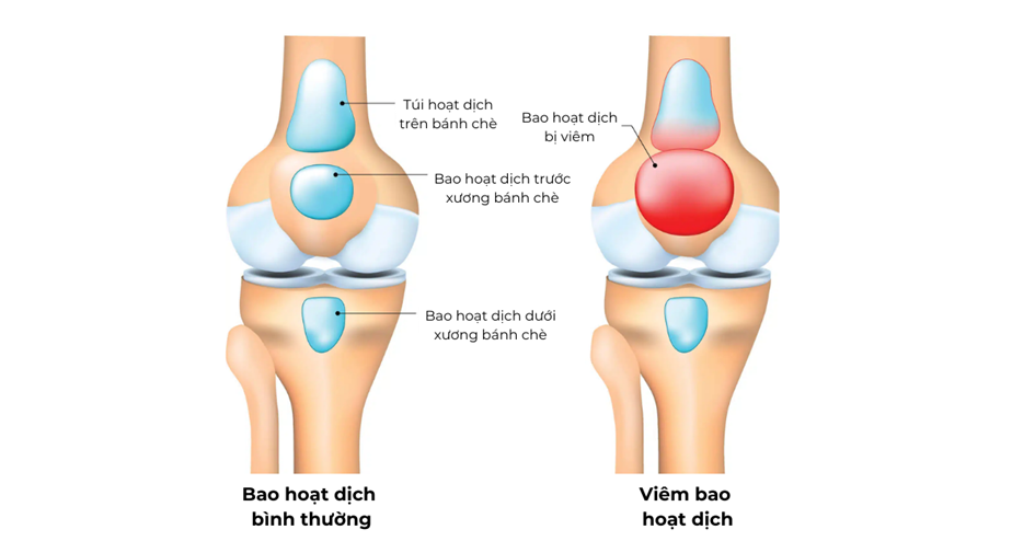 Viêm bao hoạt dịch khớp gối gây sưng đau