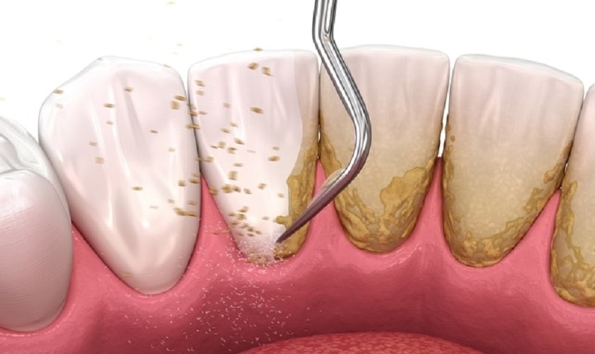 Lấy cao răng định kỳ và vệ sinh răng miệng kỹ càng để cải thiện bệnh