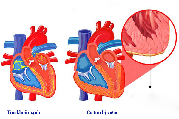 Viêm cơ tim là một bệnh viêm nhiễm của tim.