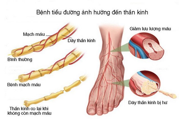 Tiểu đường là một trong những nguyên nhân gây viêm dây thần kinh
