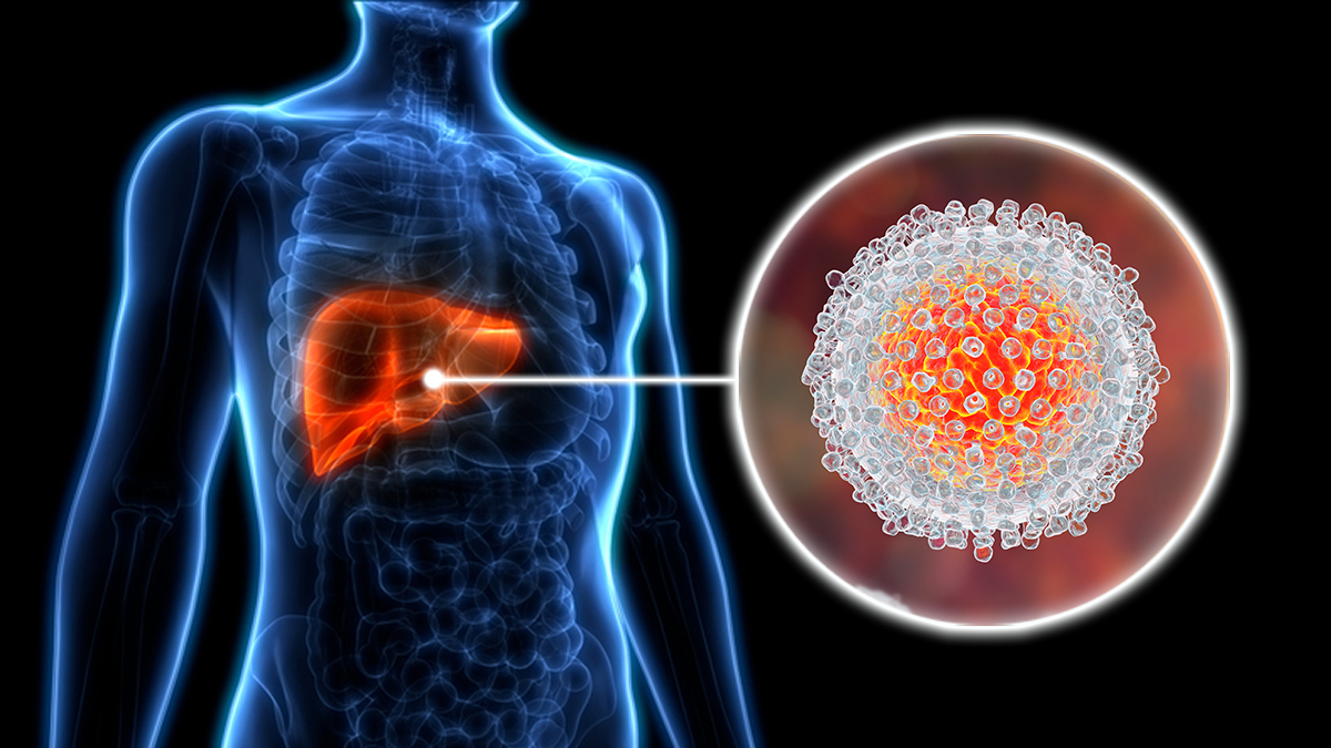 Viêm gan C là bệnh do virus gây ra