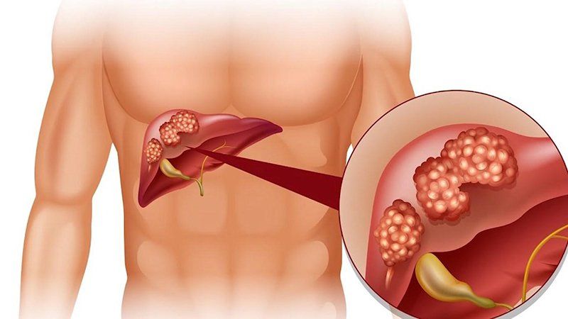 Hỗ trợ bệnh nhân viêm gan mãn tính