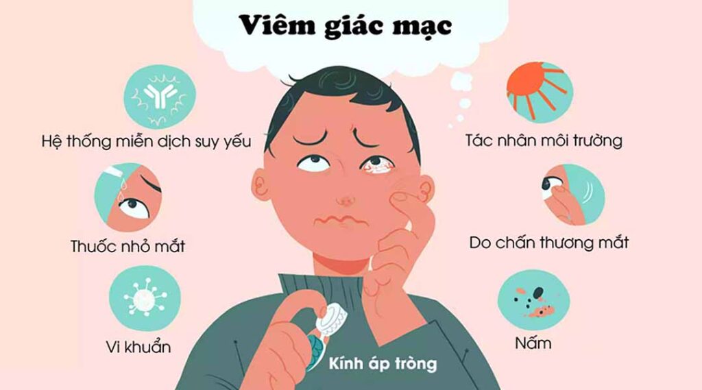 Nguyên nhân gây ra viêm giác mạc 