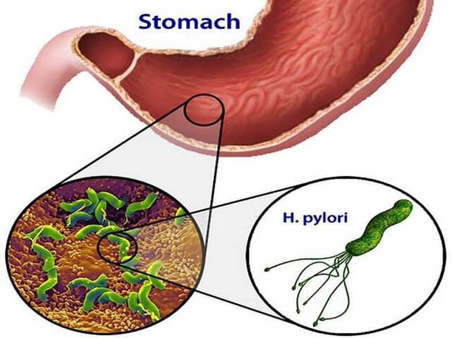 Vi khuẩn Helicobacter pylori là nguyên nhân chính gây ra viêm hang vị dạ dày