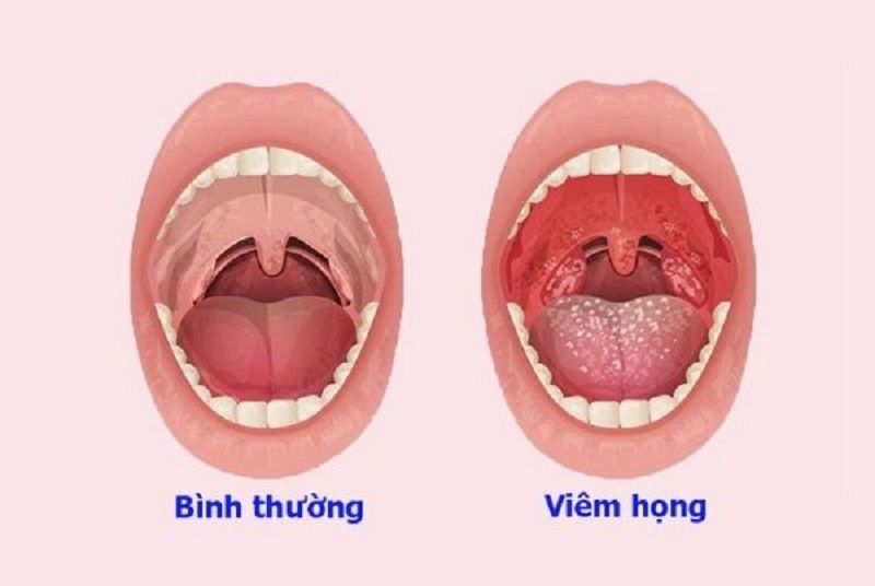 Những biểu hiện điển hình khi bệnh nhân bị viêm họng