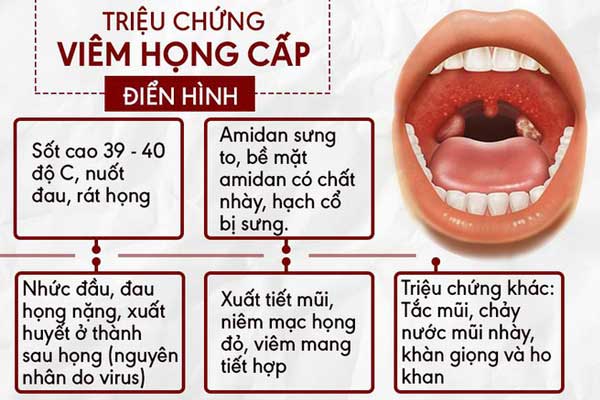 Viêm họng cấp 