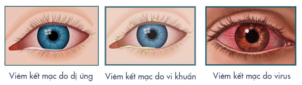 Phân biệt các dạng viêm kết mạc