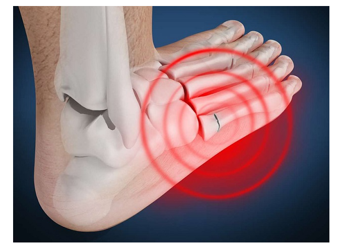 Đau bàn chân là triệu chứng của viêm khớp bàn chân