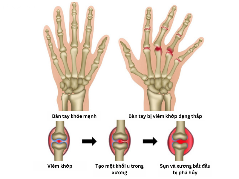 Bệnh viêm khớp dạng thấp có chữa được không?