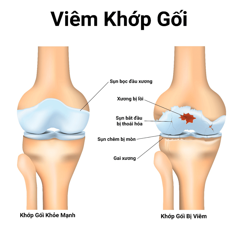 Khớp gối bình thường và bị viêm