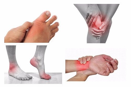 Viêm khớp và thoái hóa khớp khác nhau - Hiểu rõ để phòng tránh và điều trị hiệu quả