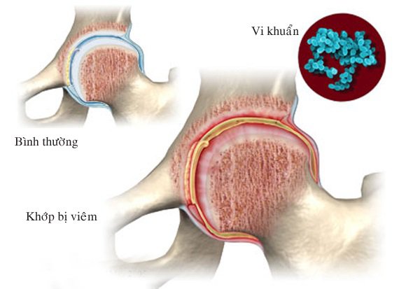 Biến chứng nguy hiểm của viêm khớp nhiễm khuẩn sinh mủ