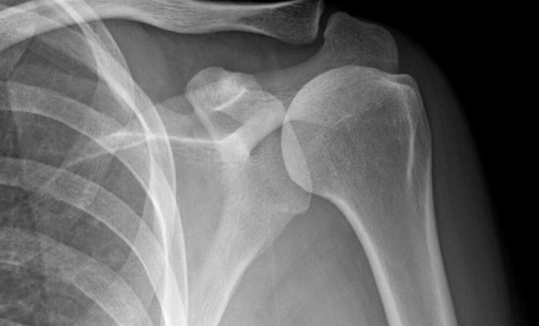 chẩn đoán viêm khớp vai