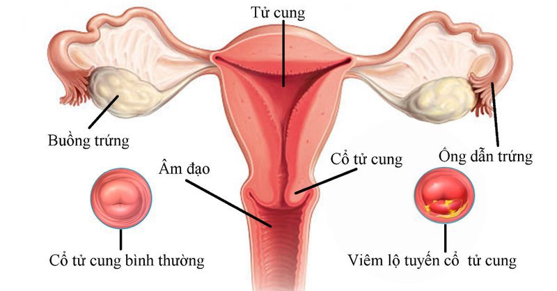 Quan Hệ Bị Đau Ở Cổ Tử Cung: Nguyên Nhân, Triệu Chứng Và Giải Pháp Hiệu Quả