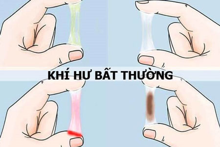 Khí hư bất thường là một trong những triệu chứng dễ nhận biết