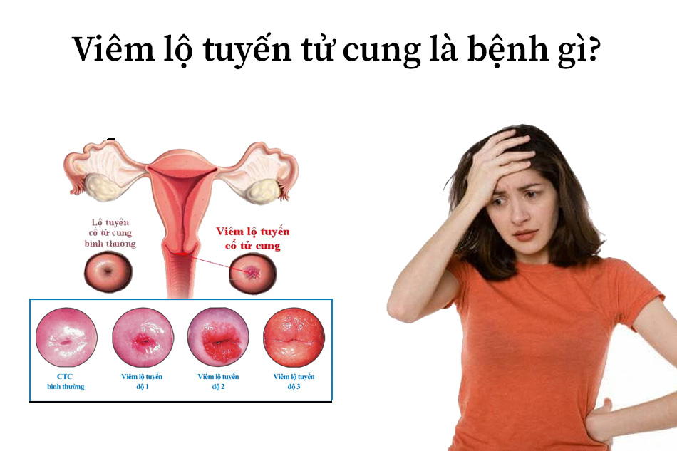 Hình ảnh viêm lộ tuyến tử cung