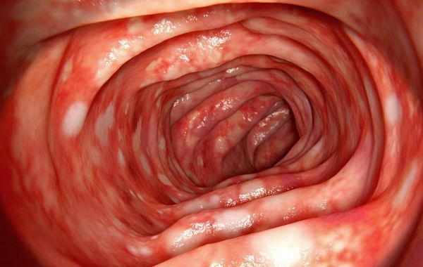 Biến chứng của viêm loét đại tràng có thể gây ảnh hưởng nghiêm trọng đến sức khỏe toàn thân