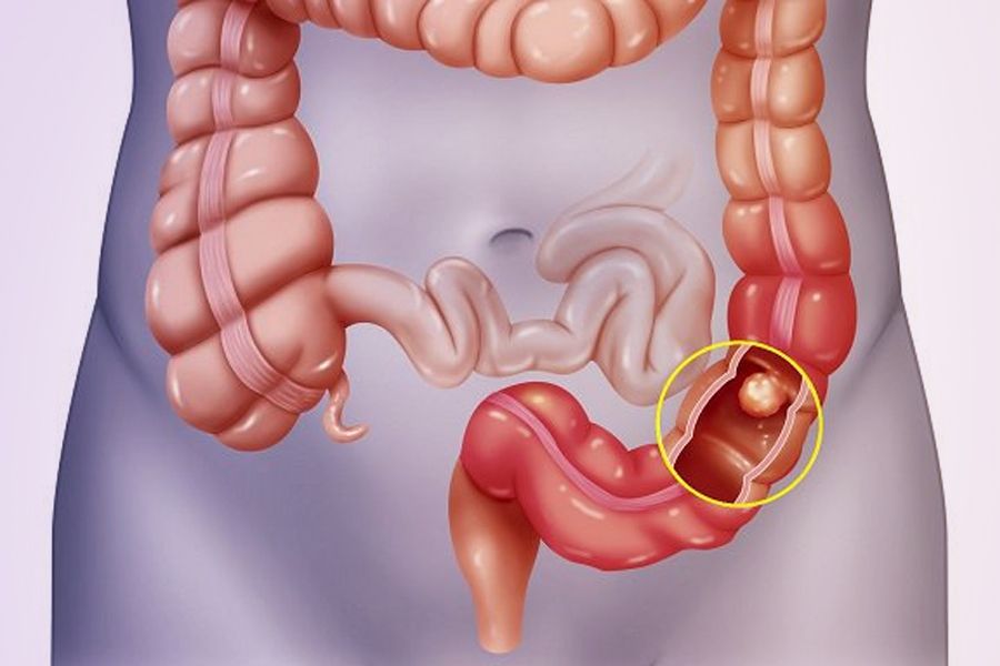 Chế độ ăn uống khoa học và tinh thần lạc quan giúp kiểm soát bệnh viêm loét đại tràng hiệu quả