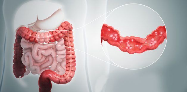 Chảy máu trực tràng và rối loạn tiêu hóa là những dấu hiệu cảnh báo viêm loét đại tràng nghiêm trọng