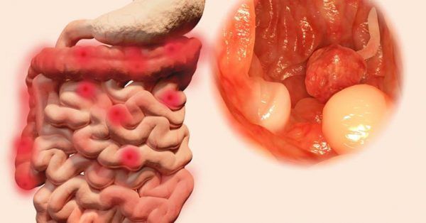 Hình ảnh niêm mạc đại tràng bị viêm và loét trong bệnh viêm loét đại trực tràng chảy máu