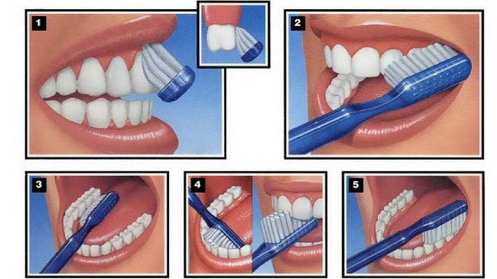 Vệ sinh răng miệng trị viêm lợi
