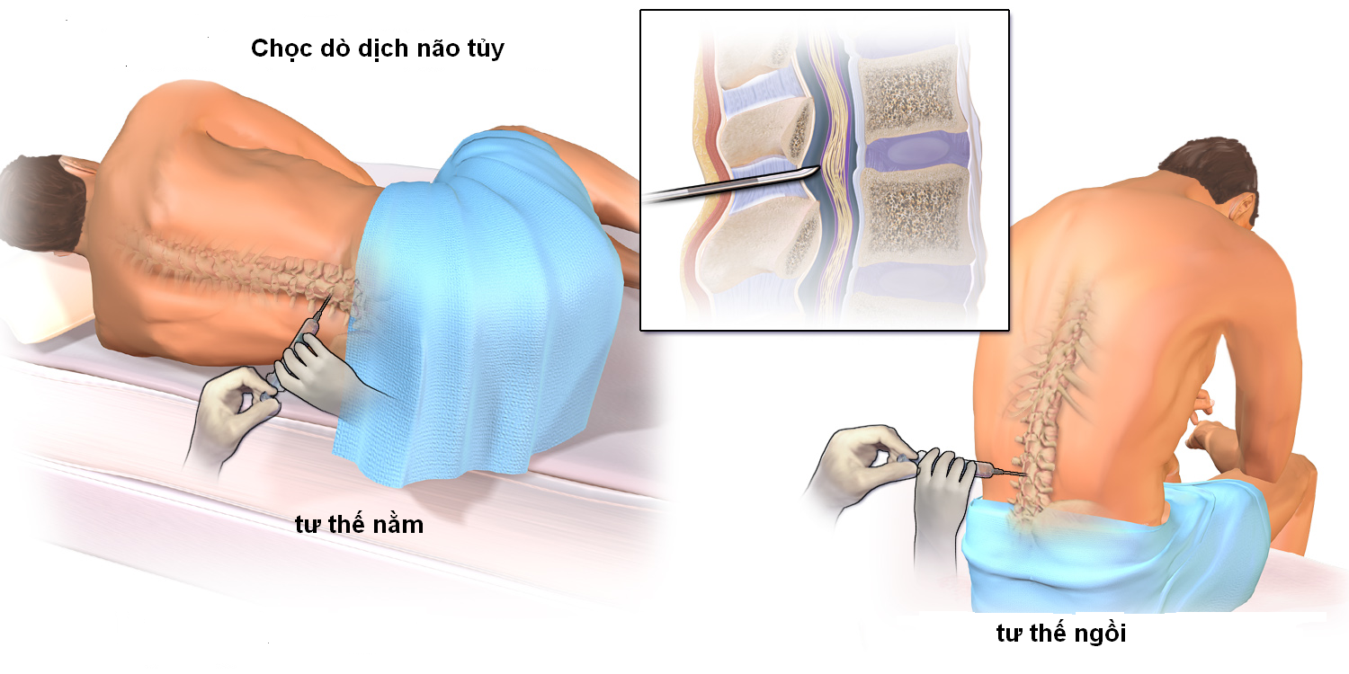 Chọc dịch não tủy