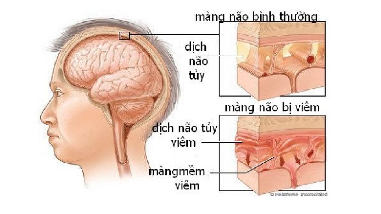 Bệnh viêm màng não do mô cầu để lại biến chứng nặng nề cho hệ thần kinh