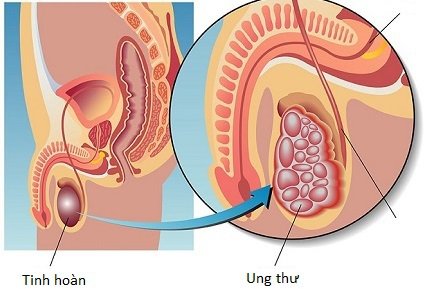 Ung thư tinh hoàn: các tế bào ung thư nhân lên nhanh chóng