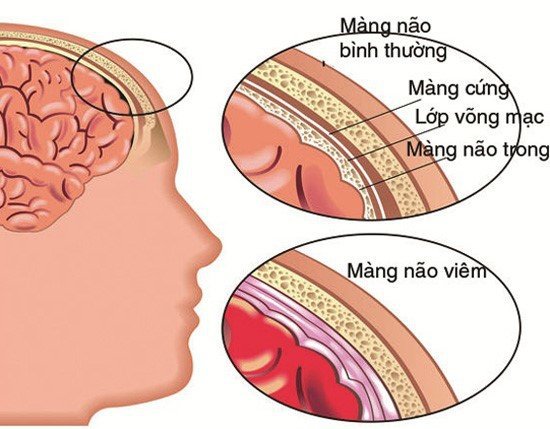 Bệnh viêm não tự miễn là một dạng bệnh viêm não