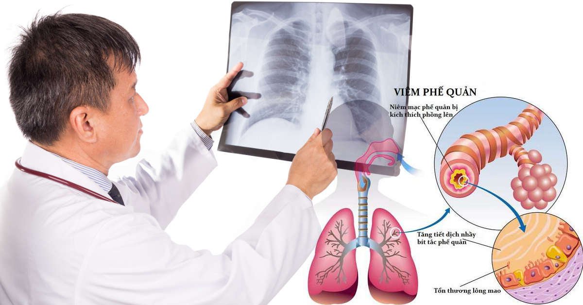 Điều trị viêm phế quản