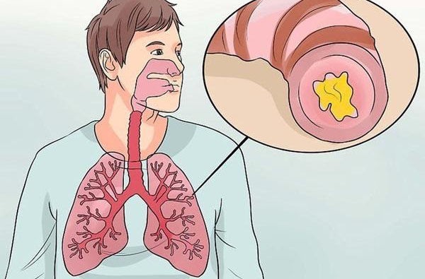 Viêm phế quản mãn tính gây nên tình trạng khó thở, ho nhiều kèm đờm đặc