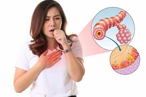 Ho là một dấu hiệu của viêm phế quản cấp