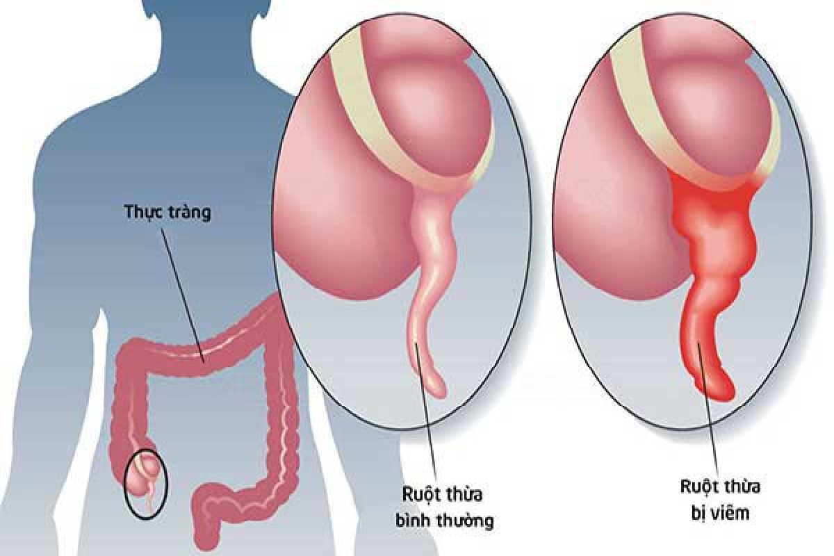 Những biện pháp tự nhiên giúp giảm đau do viêm ruột thừa