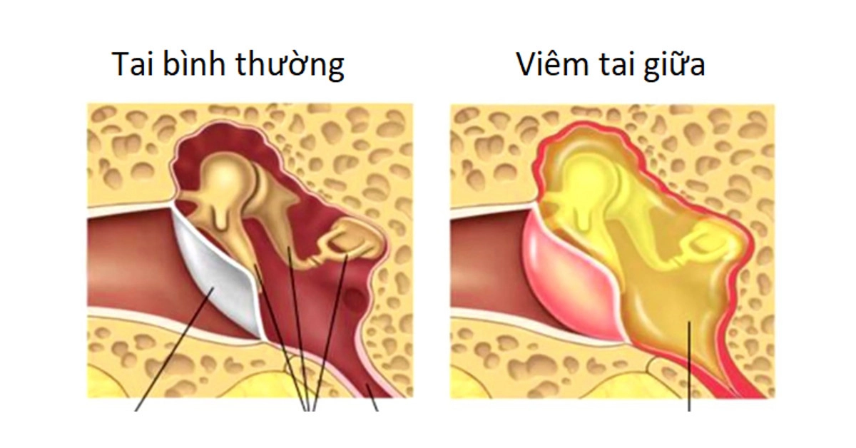 Viêm tai giữa