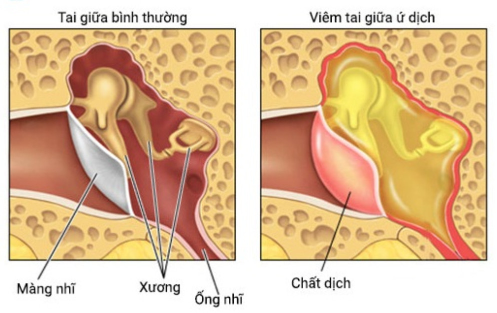 Viêm tai giữa ứ dịch là gì? Nguyên nhân, triệu chứng và cách điều trị