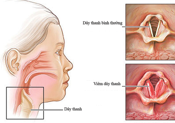 Có nhiều nguyên nhân dẫn đến viêm thanh quản.