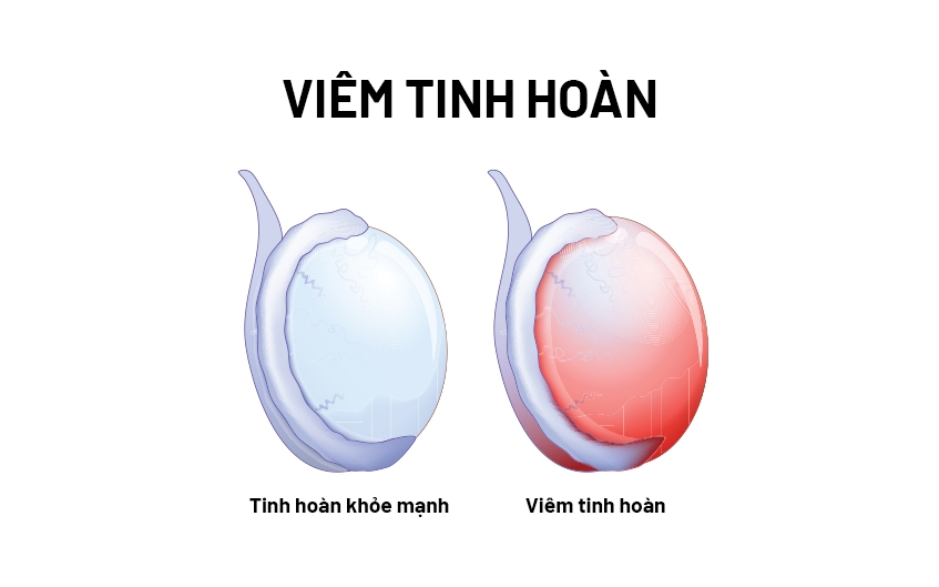 Viêm tinh hoàn nguy hiểm như thế nào?