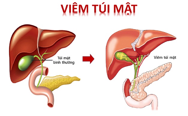 Hình ảnh túi mật bị viêm