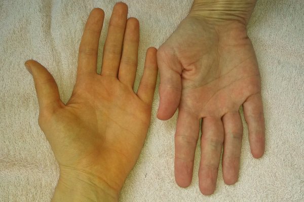 Viêm đường mật nguyên phát nặng hơn có thể gây vàng da