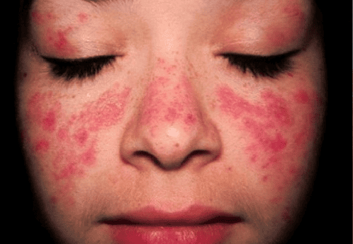 Bệnh lý lupus ban đỏ hệ thống là một trong các nguyên nhân gây viêm tủy cắt ngang