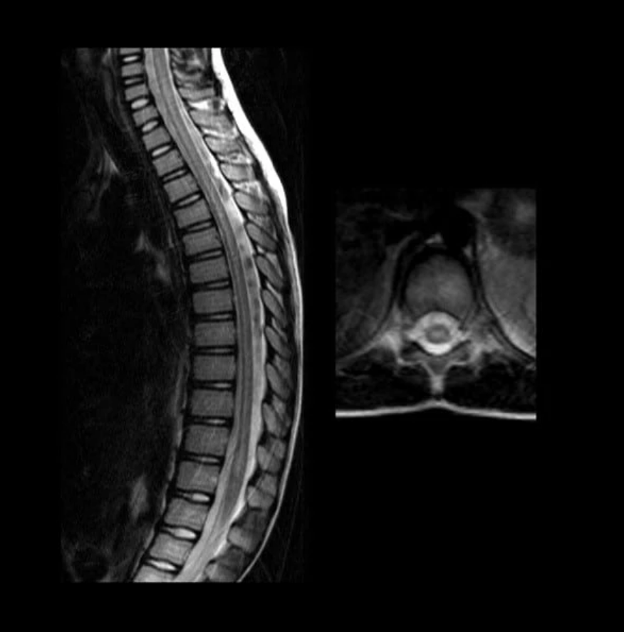 Chụp cộng hưởng từ (MRI) có thể cho thấy tình trạng viêm tủy sống