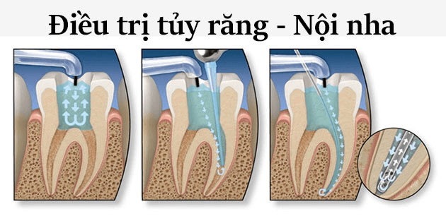 Điều trị nội nha là phương pháp phổ biến nhất điều trị viêm tủy răng do sâu răng