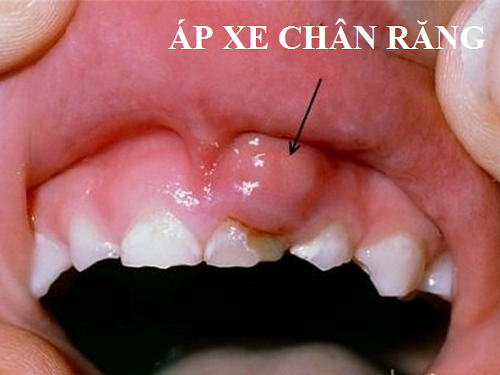 Áp xe răng là một biến chứng nguy hiểm của viêm tủy răng