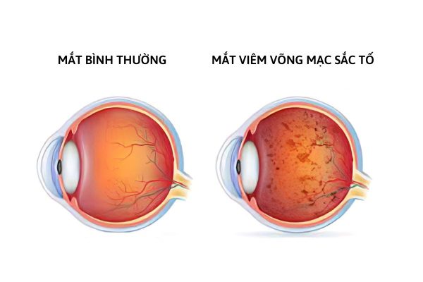 Viêm võng mạc là gì? 