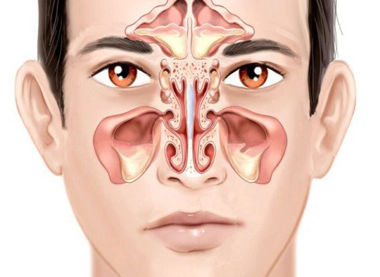 VIÊM XOANG HÀM TRÁI CÓ THỂ GÂY BIẾN CHỨNG NẾU KHÔNG ĐƯỢC ĐIỀU TRỊ