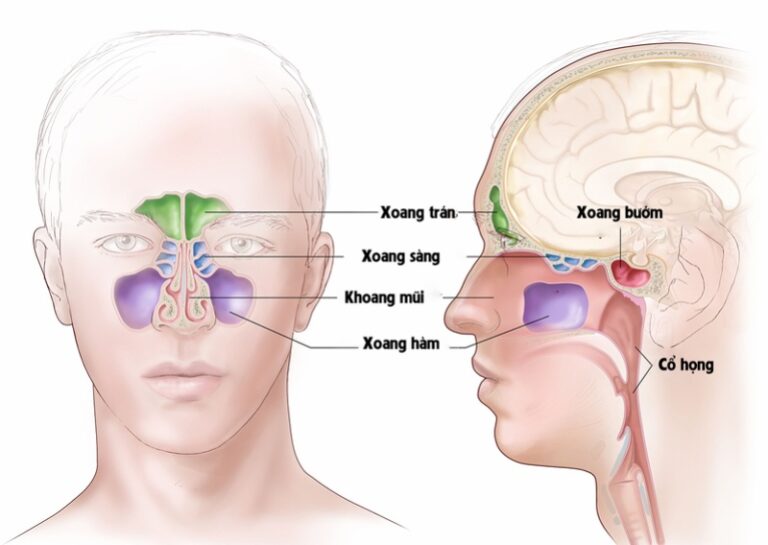 Viêm xoang sàng là do dịch nhầy và dịch mủ ứ đọng, gây bít tắc và áp lực cho bộ phận khác