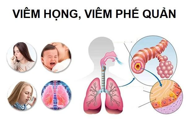 Một số triệu chứng của viêm phế quản mạn tính