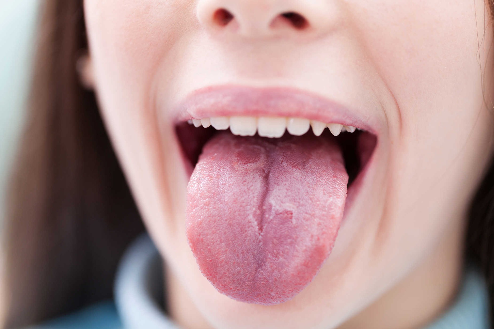 Viêm lưỡi do thiếu vitamin: Nguyên nhân và cách bổ sung